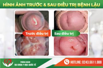 Bệnh Lậu Là Gì? Có Nguy Hiểm Không? Chi Phí Điều Trị Bệnh Lậu